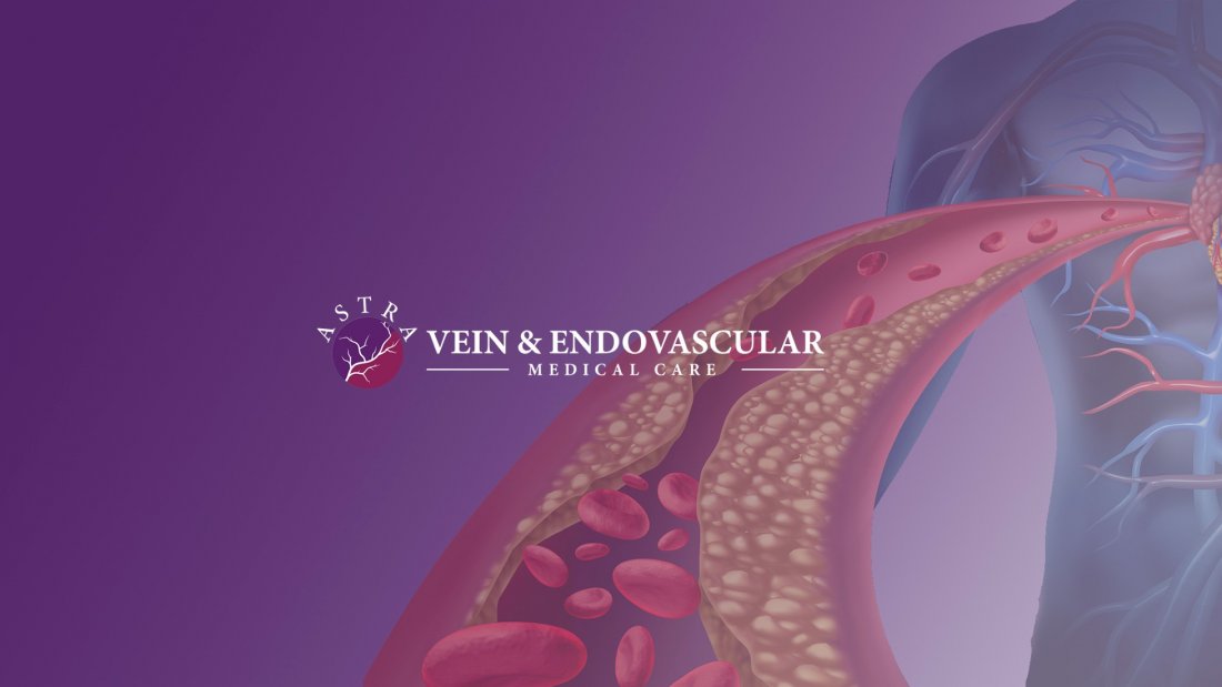 Advantages of Services in Astra Vein Treatment Center Tickets Astra